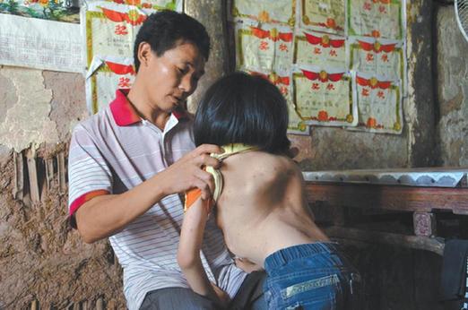 有嚴(yán)重脊椎畸形及胸腔隆突病的李文霞。