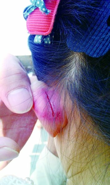 　　女童的耳朵被老師揪裂。圖片由女童家人提供