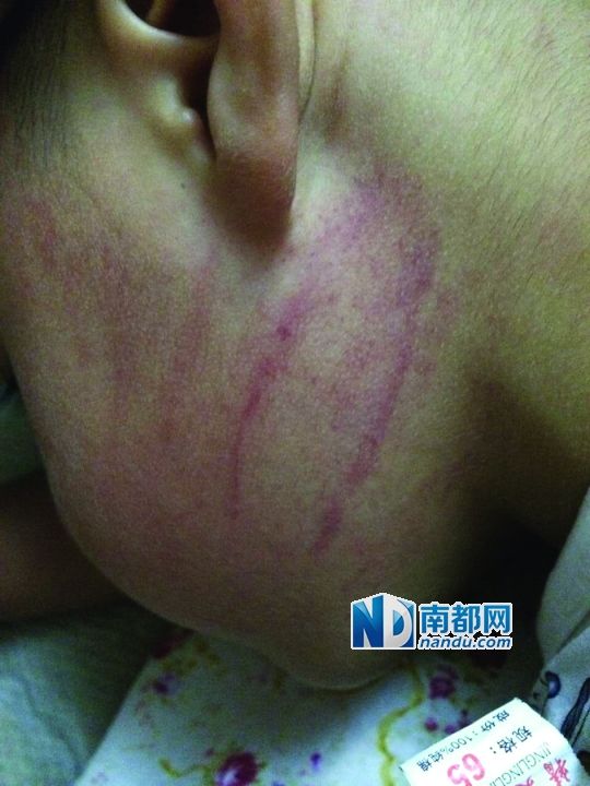 小逸臉上淤痕清晰可見(jiàn)。
