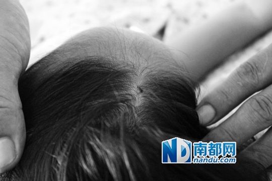 女童頭上被扎的針孔（圓圈處）。賈先生說，被扎不到三秒鐘，女兒就昏了。
