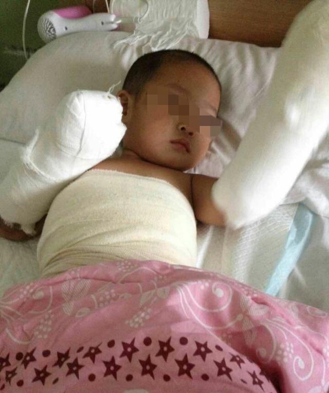 2歲娃洗澡跌入開水鍋 雙手嚴(yán)重燙傷 2歲娃洗澡跌入開水鍋 雙手嚴(yán)重燙傷