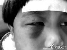 6月2日，網(wǎng)曝渭南市臨渭區(qū)一不滿5歲的女童遭奶奶毆打，眼圈青腫，引起網(wǎng)友關注，但孩子父母和爺爺均稱是摔倒導致。相關部門介入調查發(fā)現(xiàn)確為奶奶毆打所致，鑒于其身體原因已進行批評教育。