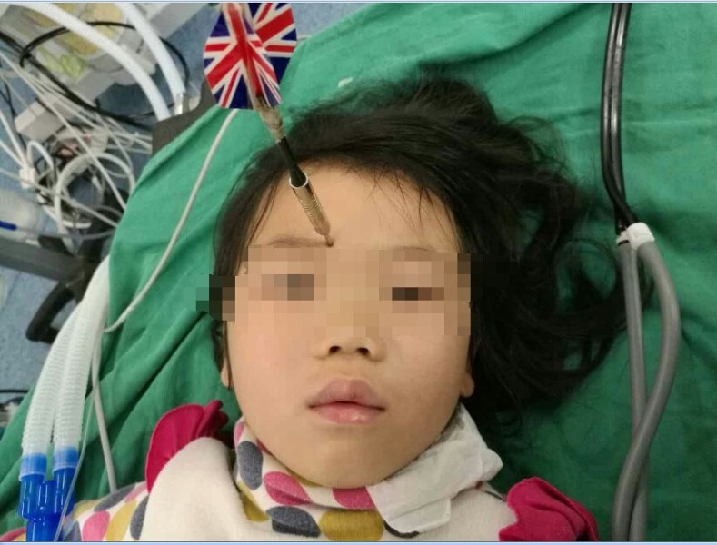 十多公分長的飛鏢穩(wěn)穩(wěn)地 ” 定 ” 在了一名六歲半的女童額頭上，小青一家人凌晨從長順趕到貴醫(yī)附院急診室時(shí)，看到如此慘烈的情況，接診醫(yī)生都嚇了一跳。詳細(xì)詢問下得知，原來是七歲的哥哥和六歲半的表妹在玩耍時(shí)，哥哥不慎將路邊撿來的真飛鏢扎到了妹妹的額頭上。