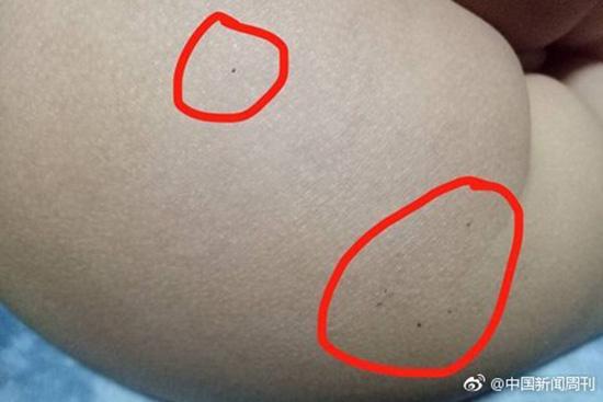 據(jù)多名紅黃藍(lán)(新天地分園)家長(zhǎng)反映，孩子腿部、屁股、腋下出現(xiàn)針眼。