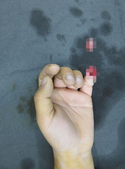 嚇哭！6歲男孩被夾斷手指 罪魁禍?zhǔn)拙故切７? oldsrc=