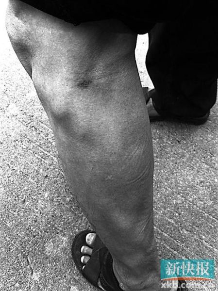 傷者身上遺留的彈痕。