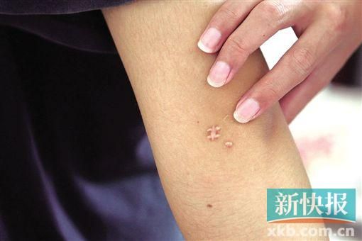 取出針后李星兒手臂留下了傷口。新快報(bào)記者 張國(guó)鋒/攝