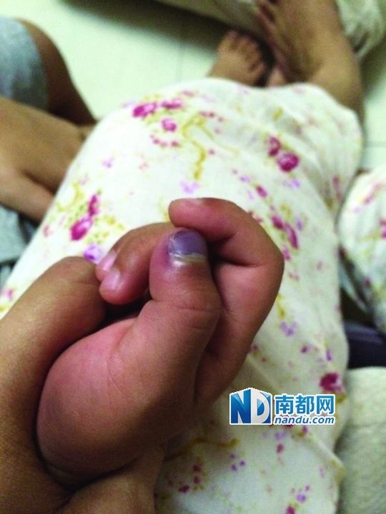 小逸手指被夾傷。