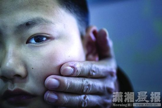 1月13日，小玨的父親心疼地摸著兒子的臉。
