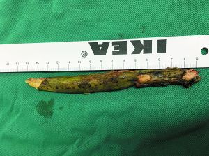 插入男子腦內(nèi)的樹枝。