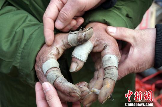 圖為由于常年拾荒，老人雙手布滿傷口。周小云 攝